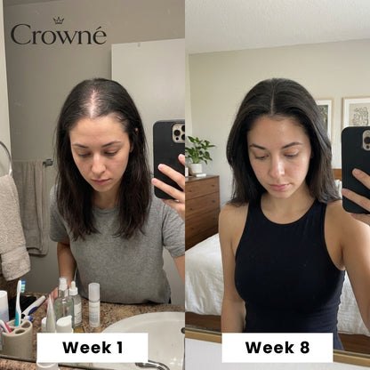 Regrow Visibly Thicker, Fuller Hair - Crowné™ Hair Revival System